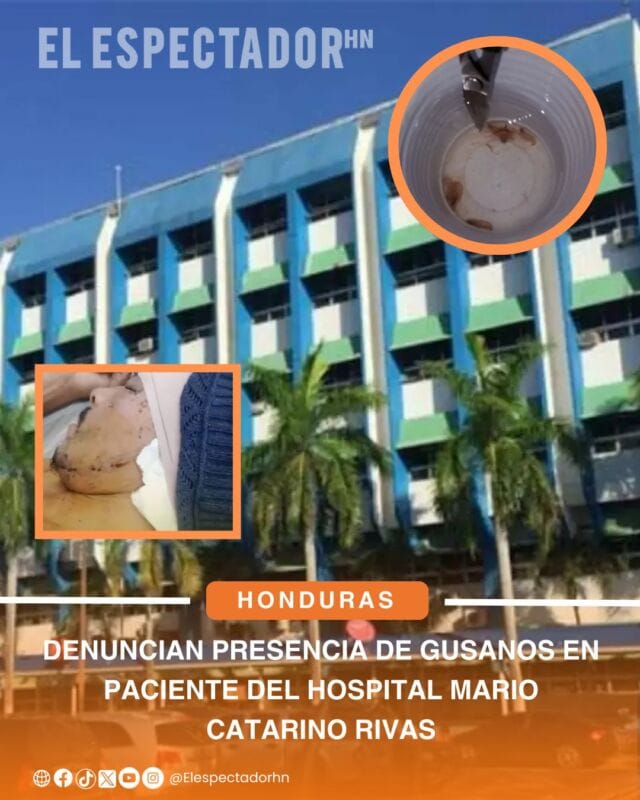 Denuncian presencia de gusanos en paciente del Hospital Mario Catarino Rivas
