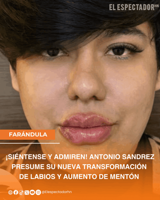 ¡Siéntense y admiren! Antonio Sandrez presume su nueva transformación de labios y aumento de mentón