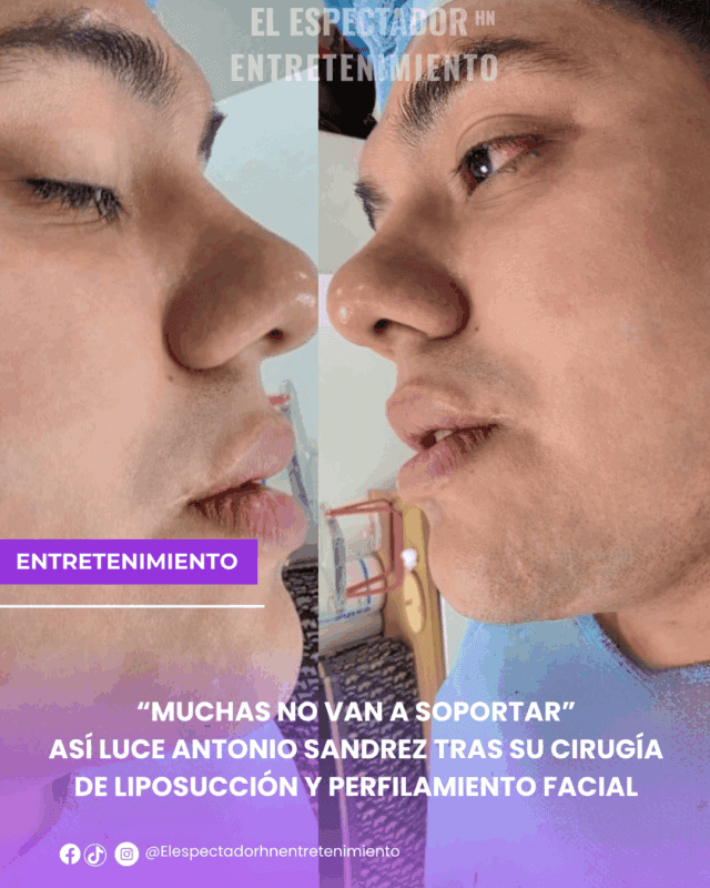 así luce Antonio Sandrez tras su cirugía de liposucción y perfilamiento facial