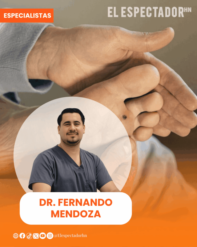 Dr. Fernando Mendoza advierte sobre los riesgos de no tratar las verrugas plantares