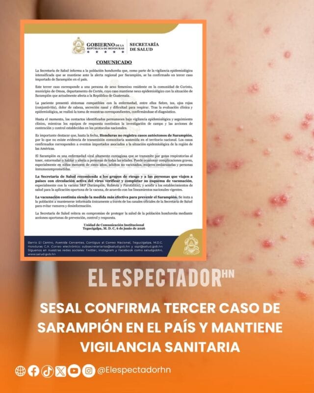 sarampión