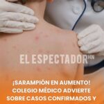 ¡Sarampión en aumento! Colegio Médico advierte sobre casos confirmados y llama a vacunarse