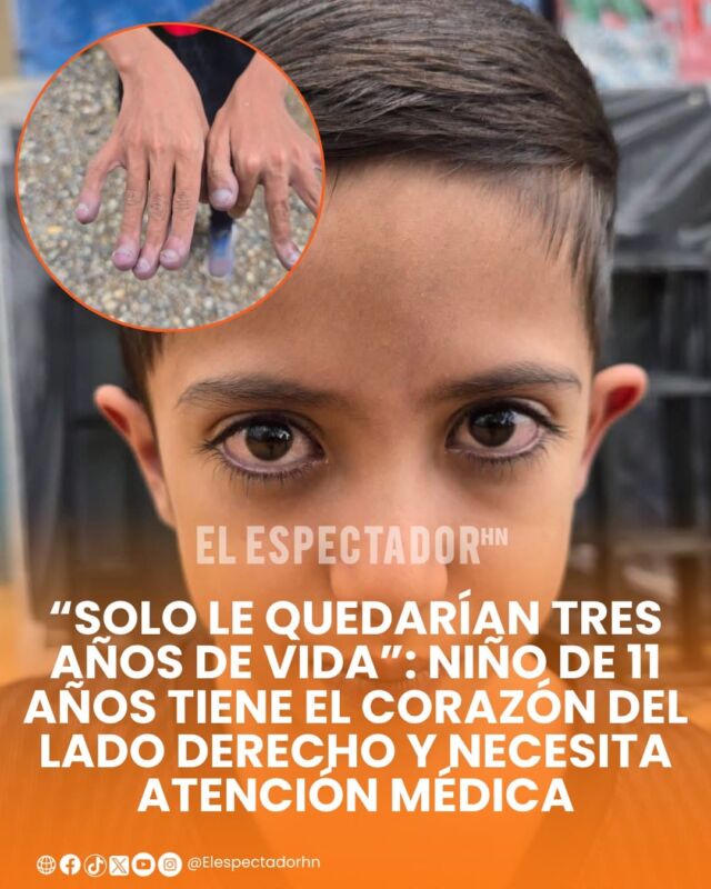 
“Solo le quedarían tres años de vida”: niño de 11 años tiene el corazón del lado derecho y necesita atención médica
